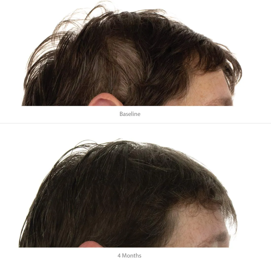 FOLIGAIN Hair Growth Shampoo   Conditioner Kit For Women