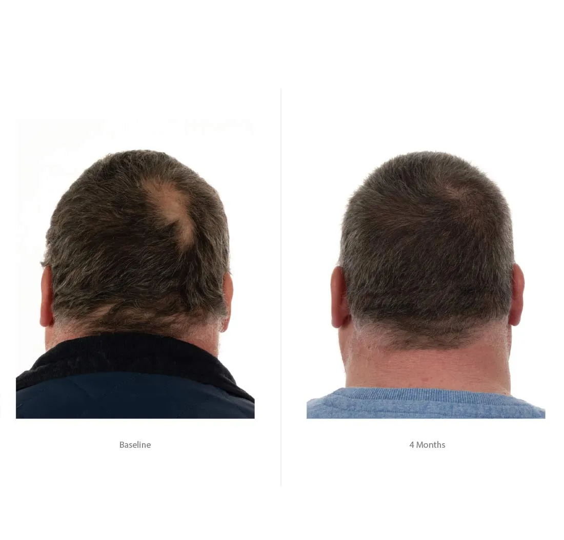 FOLIGAIN Triple Action Conditioner For Thinning Hair For Men with 2% Trioxidil 473ml